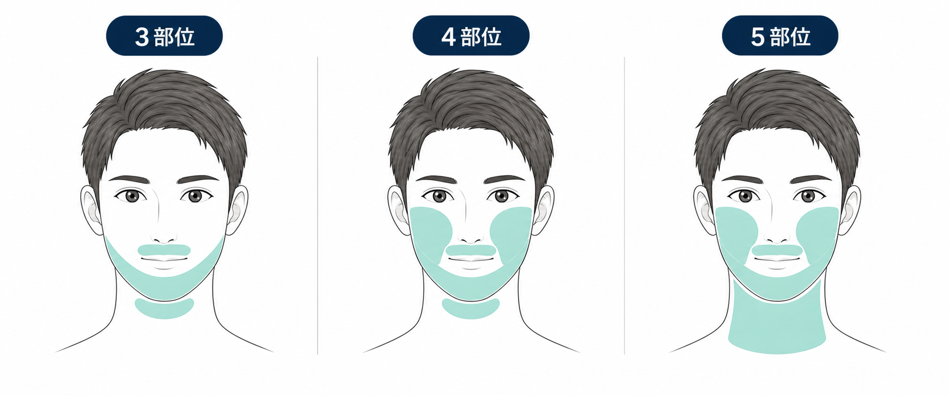ヒゲ脱毛の照射エリア